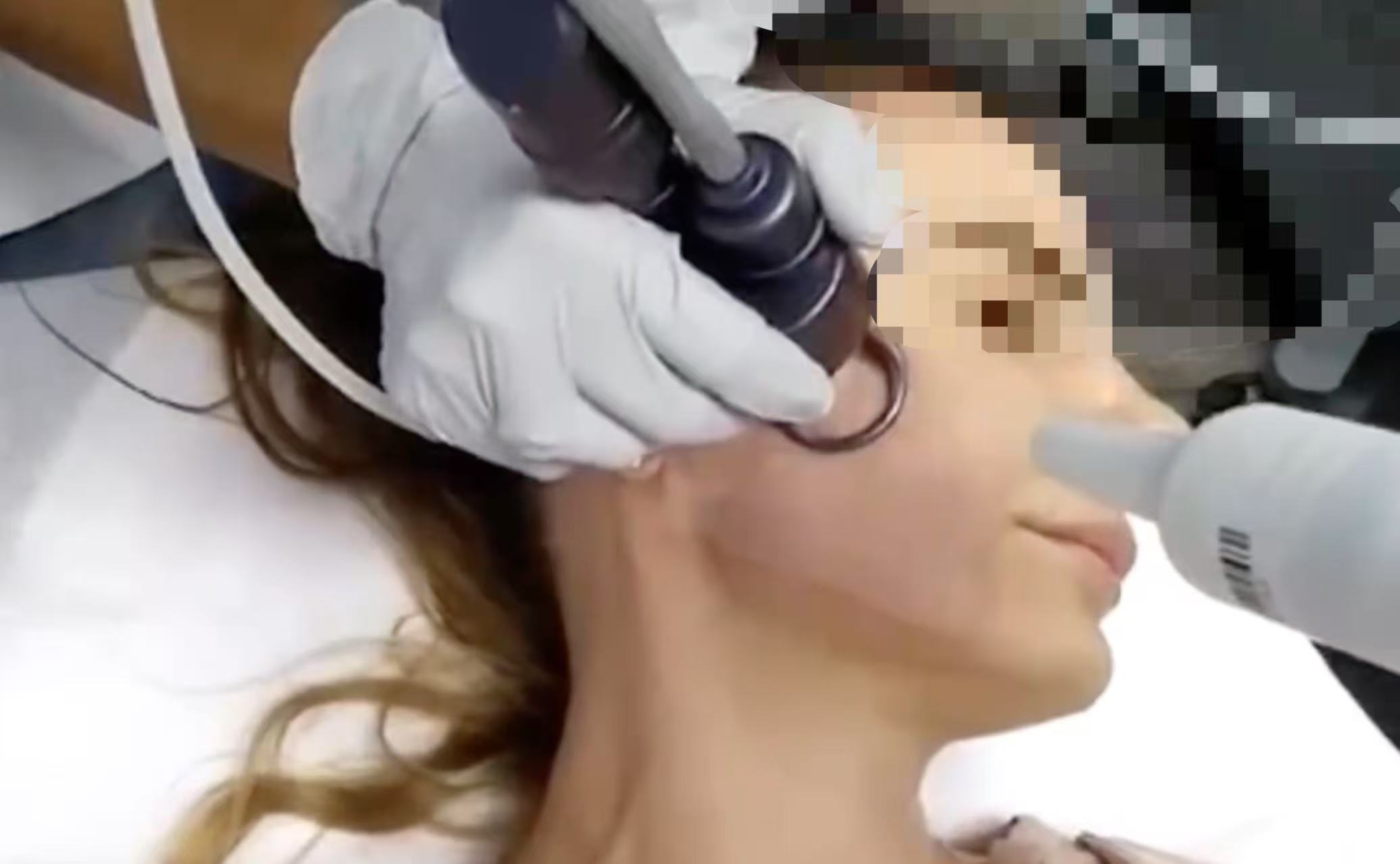 Why Every Laser Clinic Should Use a Cooling Device: More Than Just Comfort