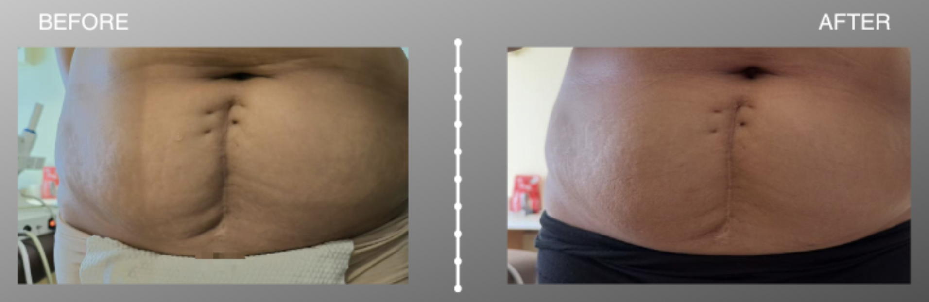 HIFU abdomen before and after treatment, postpartum woman with two children HIFU abdomen before and after treatment, postpartum woman with two children